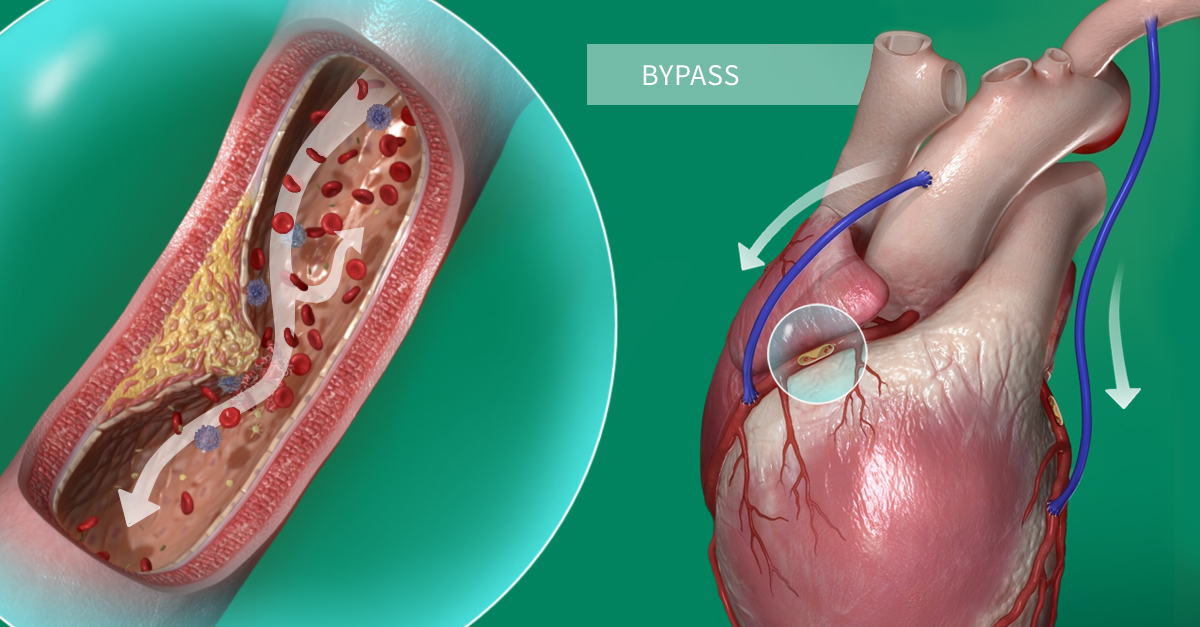 Visual of a heart with a coronary artery bypass graft. Visual of a close-up of the internal structure of a blocked coronary artery, showing that blood cannot pass properly